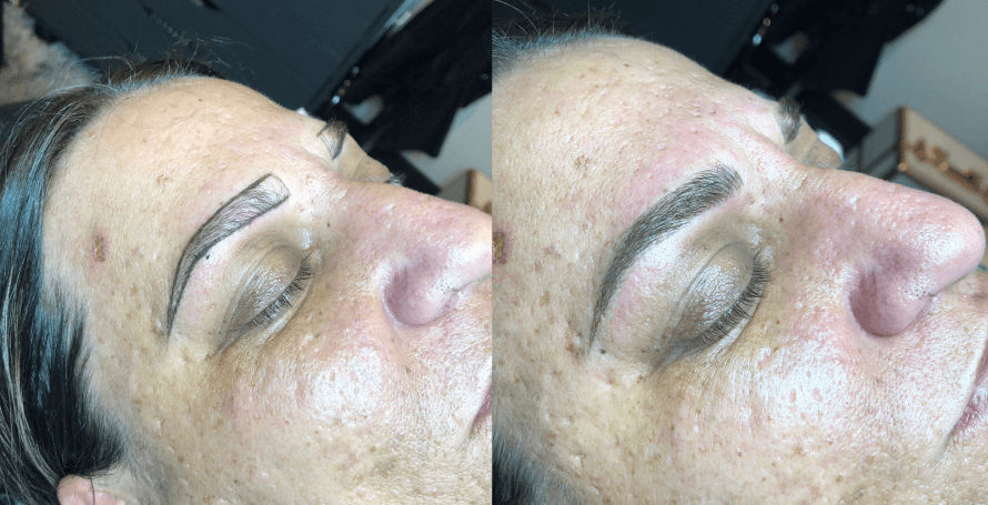 Cosmetic-Eyebrow-Tattooing-Microblading