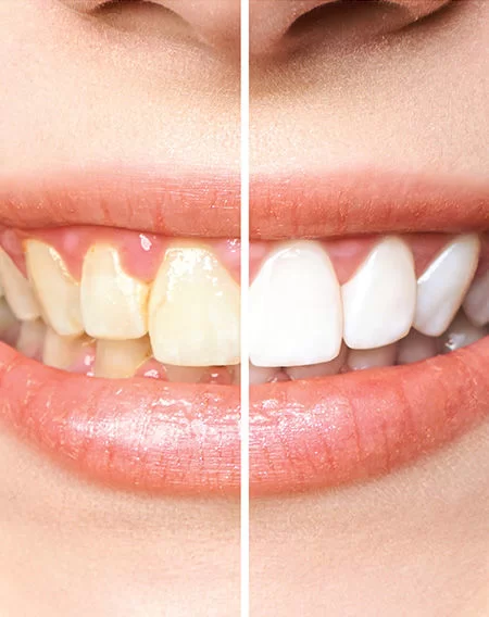 Professional teeth whitening before and after results for a brighter smile at Divine Threading and Lash Las Vegas.