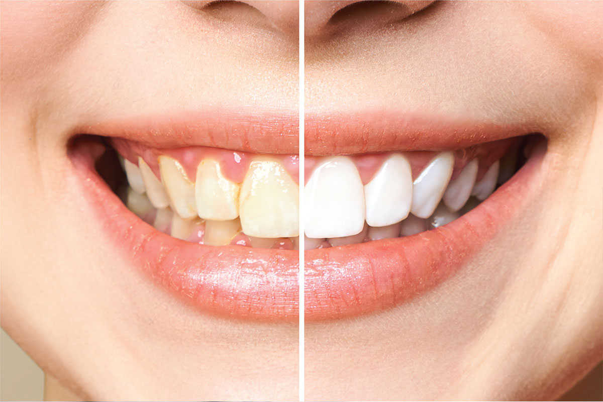 divine-teeth-whitening-service